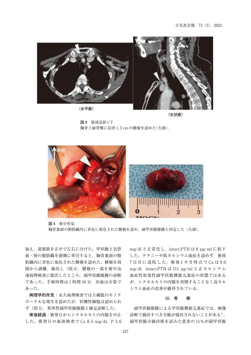38♥♥♥♥食道腫瘍の臨床病理♥♥♥♥ 38♥♥♥♥食道腫瘍の臨床病理♥♥♥♥